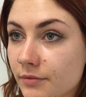 Ліпофілінг скул в Одесі - фото до