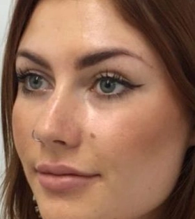 Ліпофілінг скул в Одесі - фото після