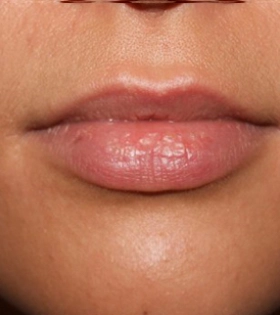 Ліпофілінг губ в Одесі - фото до
