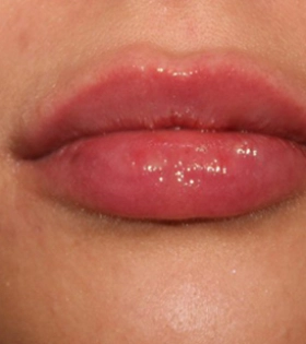 Ліпофілінг губ в Одесі - фото після