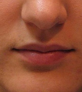 Ліпофілінг губ в Одесі - фото до