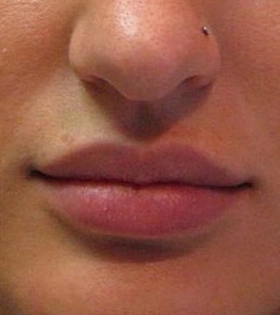 Ліпофілінг губ в Одесі - фото після