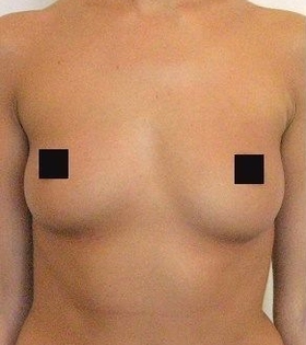 Липофилинг груди - фото до