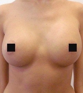 Липофилинг груди - фото після