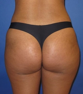 Липофилинг ягодиц - фото після