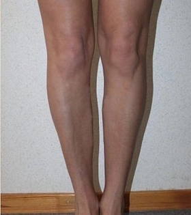 Липофилинг голеней - фото до