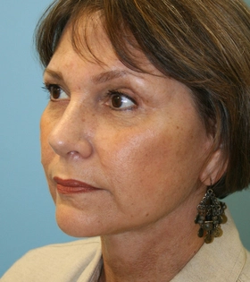 Мезонити 3D (тредлифтинг) - фото після