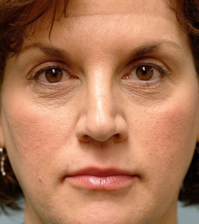 Мезотерапия для лица - фото до