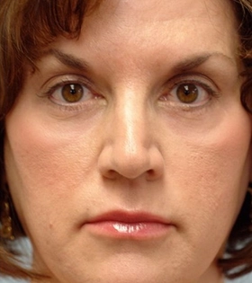 Мезотерапия для лица - фото після