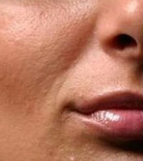 Мезотерапия для лица - фото до