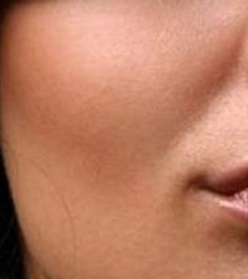 Мезотерапия для лица - фото після