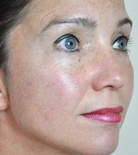 Мезотерапия для лица - фото до