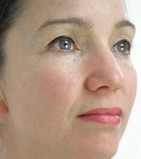 Мезотерапия для лица - фото після