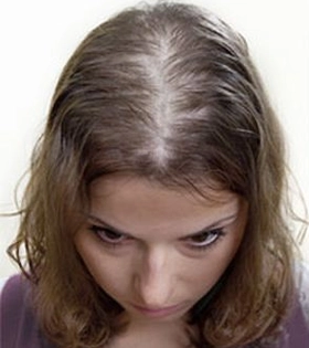 Мезотерапия для волос - фото до