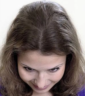 Мезотерапия для волос - фото після