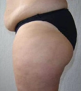 Мезотерапія тіла в Одесі - фото до