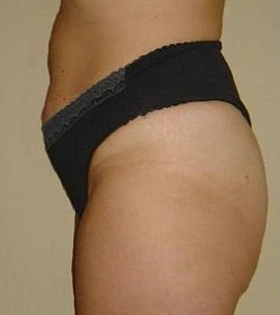 Мезотерапія тіла в Одесі - фото після