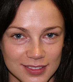 Плазмолифтинг - фото до