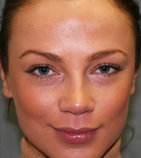 Плазмолифтинг - фото після