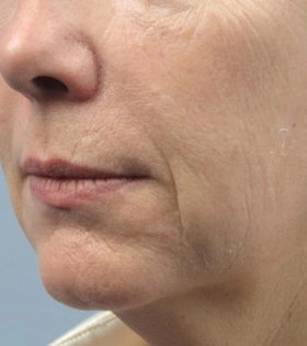 Плазмолифтинг - фото до