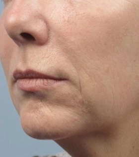 Плазмолифтинг - фото після