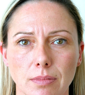 Уколи краси (ботулінотерапія) в Одесі - фото до