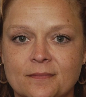 Лазерное удаление пигментации - фото до