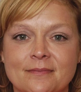 Лазерное удаление пигментации - фото після