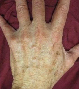 Лазерное удаление пигментации - фото до