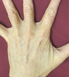 Лазерное удаление пигментации - фото після