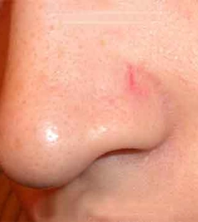 Лазерное удаление сосудов - фото до