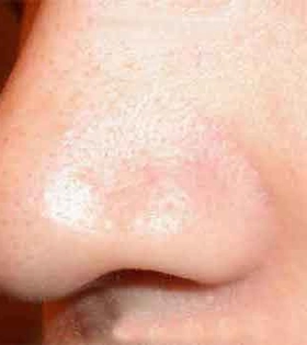 Лазерное удаление сосудов - фото після