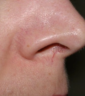 Лазерное удаление сосудов - фото до