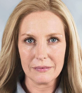 Мезонити 3D (тредлифтинг) - фото до