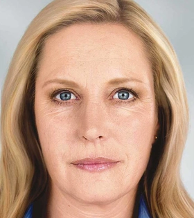 Мезонити 3D (тредлифтинг) - фото після