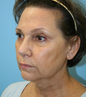 Мезонити 3D (тредлифтинг) - фото до