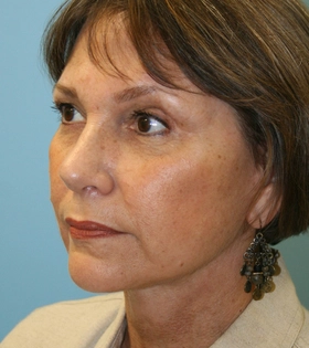 Мезонити 3D (тредлифтинг) - фото після