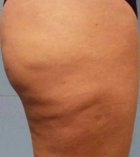 Ультразвуковой SMAS лифтинг тела - фото до