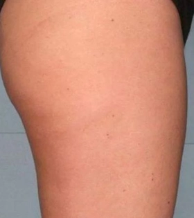 Ультразвуковой SMAS лифтинг тела - фото після