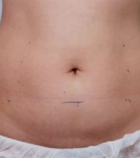 Ультразвуковой SMAS лифтинг тела - фото до