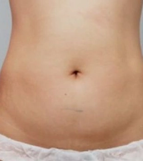 Ультразвуковой SMAS лифтинг тела - фото після