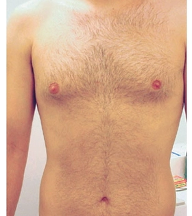 Лазерна епіляція тіла в Одесі - фото до