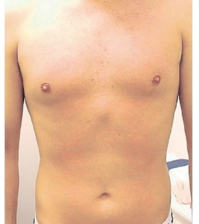 Лазерна епіляція тіла в Одесі - фото після