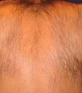 Лазерна епіляція тіла в Одесі - фото до