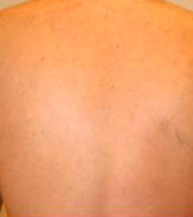 Лазерна епіляція тіла в Одесі - фото після