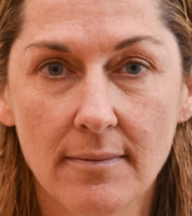 Лазерная шлифовка  кожи лица в Одессе - фото до