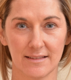 Лазерная шлифовка  кожи лица в Одессе - фото после