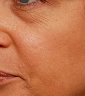 Лазерная шлифовка  кожи лица в Одессе - фото до