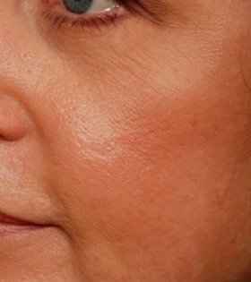 Лазерная шлифовка  кожи лица в Одессе - фото после