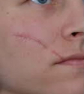 Лазерная шлифовка рубца  - фото до